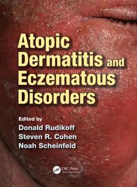 Atopic Dermatitis and Eczematous Disorders by Donald Rudikoff