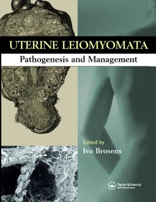 Uterine Leiomyomas: Pathogenesis and Management by Ivo Brosens