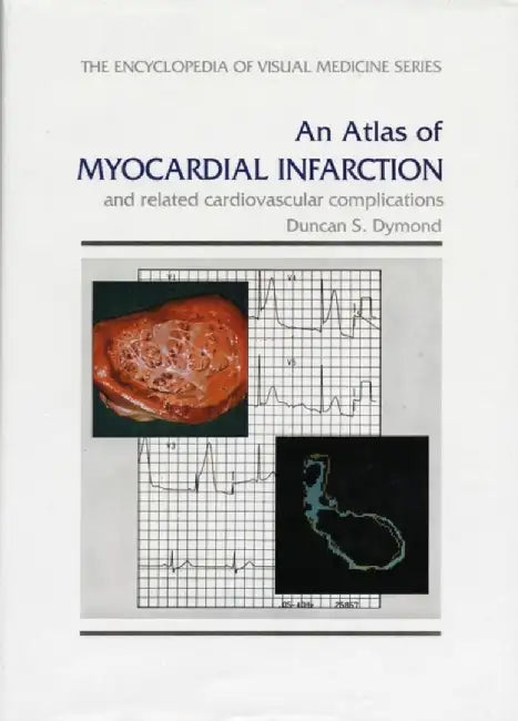 An Atlas Of Myocardial Infarction: And Related Cardiovascular Complications by D.S. Dymond