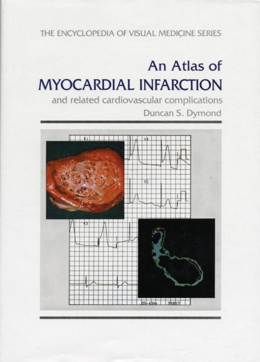 An Atlas Of Myocardial Infarction: And Related Cardiovascular Complications by D.S. Dymond