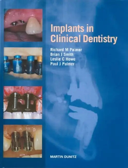 Implants in Clinical Dentistry by Palmer