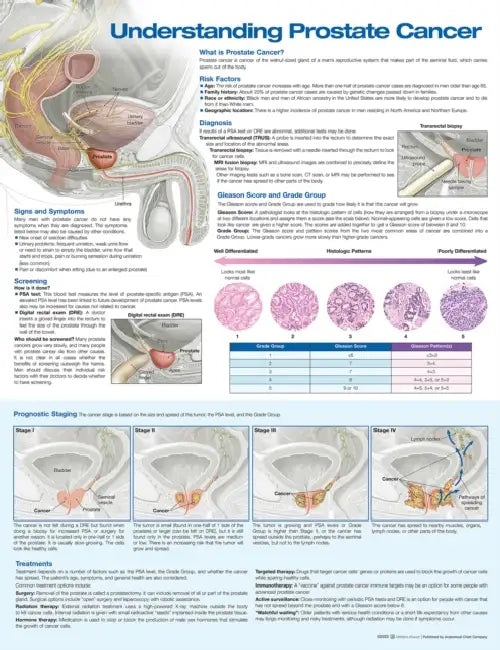 Understanding Prostate Cancer Anatomical Chart by Anatomical Chart Company (COR)