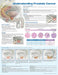 Understanding Prostate Cancer Anatomical Chart by Anatomical Chart Company (COR)