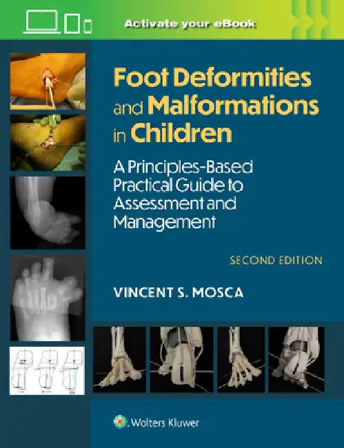 Foot Deformities and Malformations in Children by Vincent Mosca