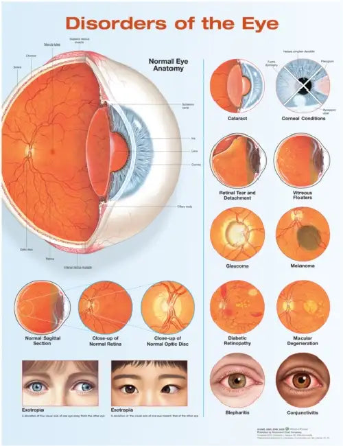 Disorders of the Eye Anatomical Chart by Anatomical Chart Company (COR)