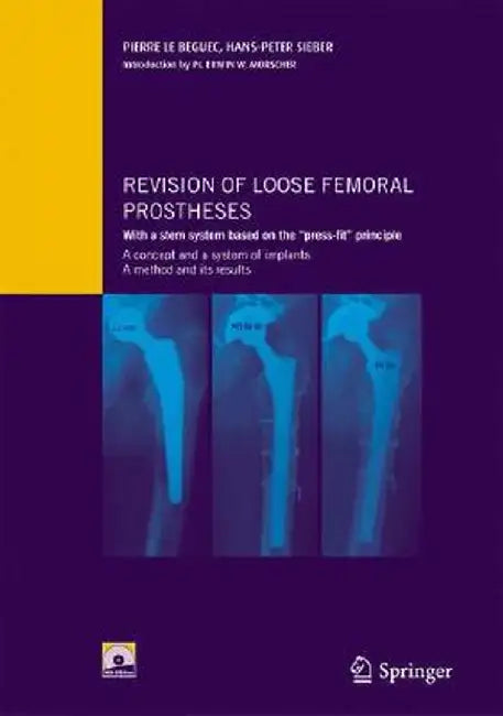 Revision of Loose Femoral Prostheses with a Stem System Based on the Press-Fit Principle: A Concept and Its System of Implants, a Method and Its Resul by Pierre Le Béguec