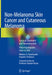 Non-Melanoma Skin Cancer and Cutaneous Melanoma: Surgical Treatment and Reconstruction by Othon Papadopoulos