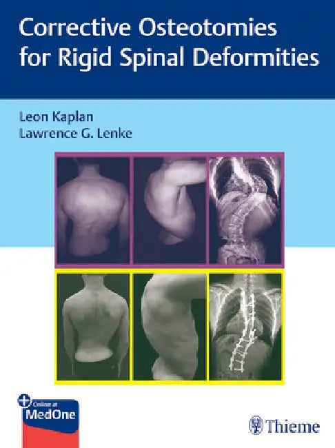 Corrective Osteotomies for Rigid Spinal Deformities by Leon Kaplan, Lawrence G. Lenke