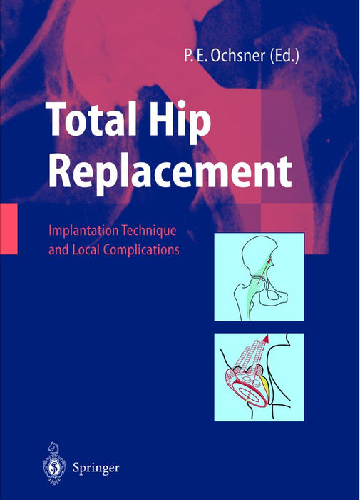Total Hip Replacement: Implantation Technique and Local Complications by P. E. Ochsner