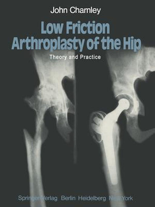 Low Friction Arthroplasty of the Hip: Theory and Practice by J. Charnley