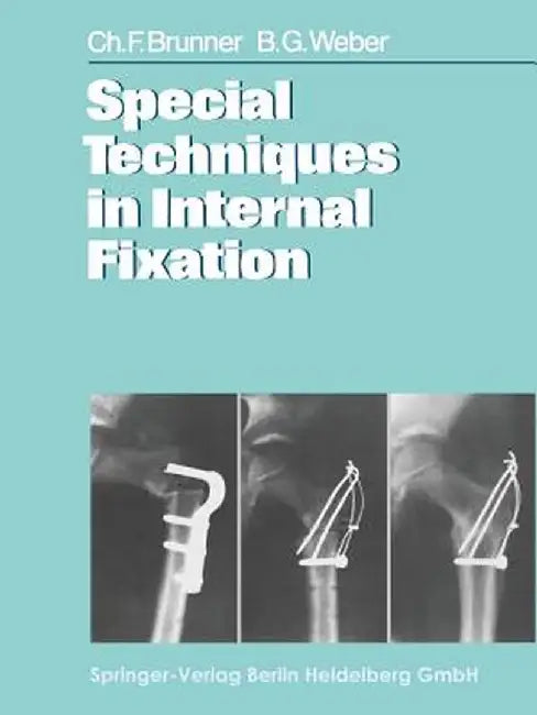 Special Techniques in Internal Fixation by C. F. Brunner