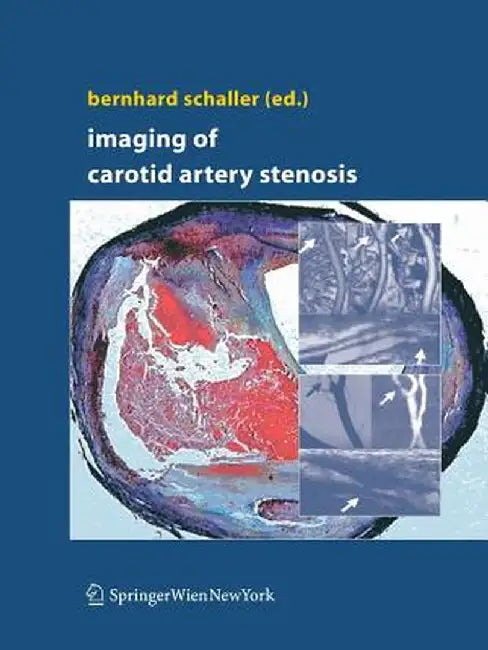 Imaging of Carotid Artery Stenosis by Bernhard Schaller