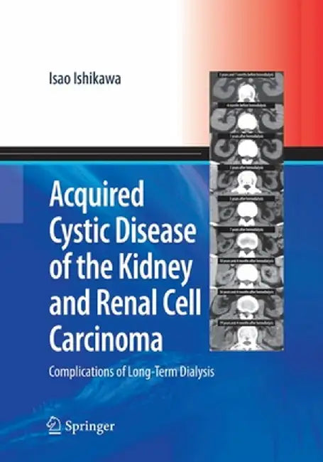 Acquired Cystic Disease of the Kidney and Renal Cell Carcinoma: Complication of Long-Term Dialysis by Isao Ishikawa