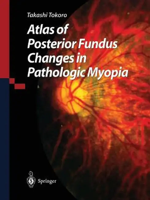 Atlas of Posterior Fundus Changes in Pathologic Myopia by Takashi Tokoro