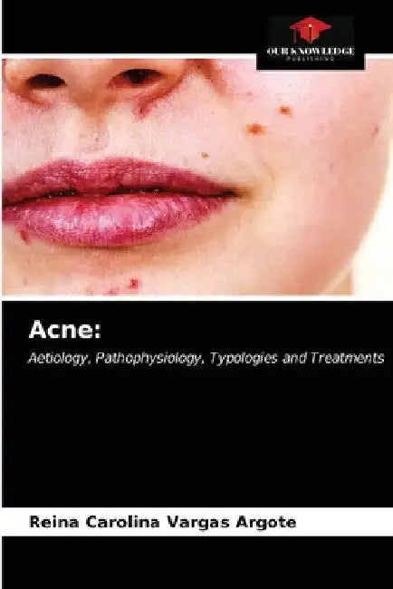 Acne by Reina Carolina Vargas Argote