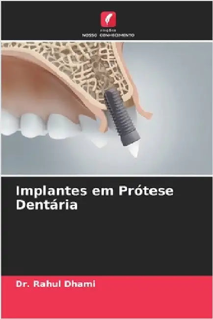 Implantes em Prótese Dentária by Dhami, Rahul