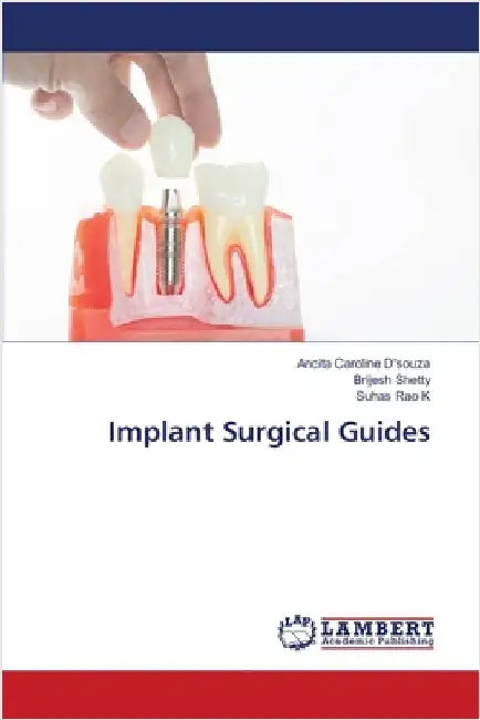 Implant Surgical Guides by Ancita Caroline D'Souza
