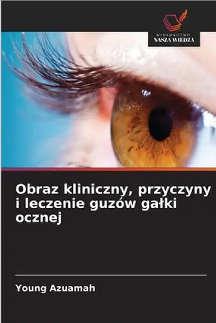 Obraz kliniczny, przyczyny i leczenie guzów galki ocznej by Young Azuamah