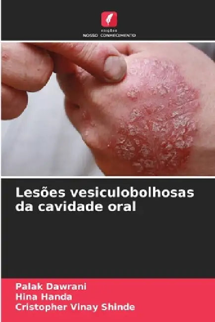 Lesões vesiculobolhosas da cavidade oral by Palak Dawrani, Hina Handa, Cristopher Vinay Shinde