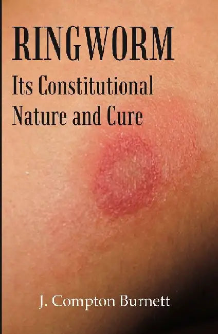 Ringworm: Its Constitutional Nature and Cure by J. Compton Burnett