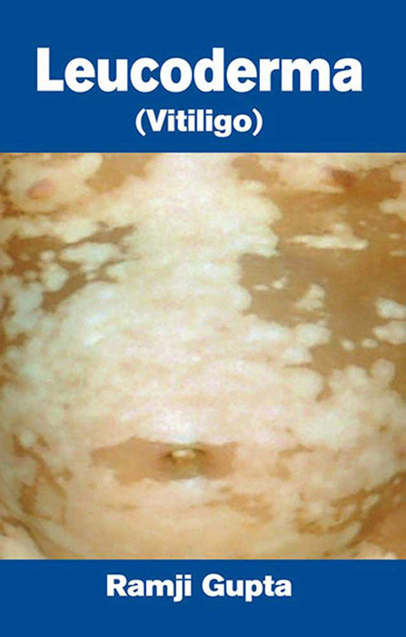 Leucoderma: Vitiligo by Ramji Gupta