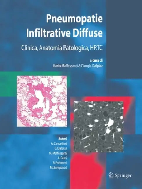 Pneumopatie Infiltrative Diffuse: Clinica, Anatomia Patologica, Hrtc by M. Maffessanti, A. Cancellieri, G. Dalpiaz