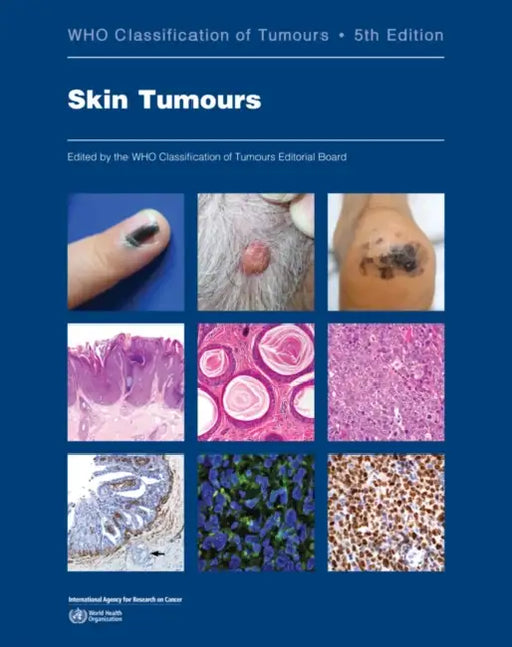 Skin Tumours: Who Classification of Tumours by Who Classification of Tumours Editorial