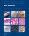 Skin Tumours: Who Classification of Tumours by Who Classification of Tumours Editorial