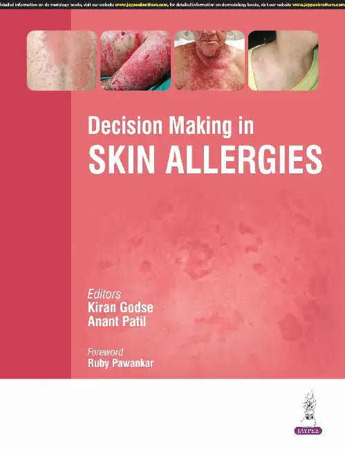 Decision Making In Skin Allergies by Kiran Godse