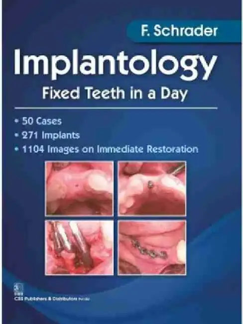 Implantology: Fixed Teeth in a Day by F. Schrader