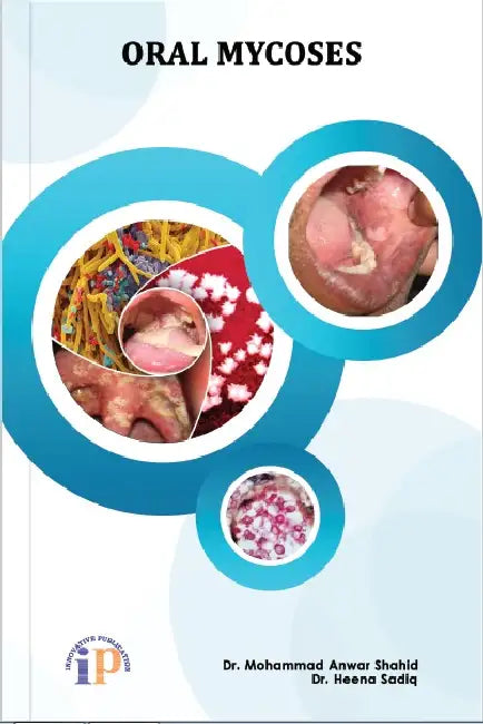 Oral Mycoses by Dr. Mohammad Anwar Shahid