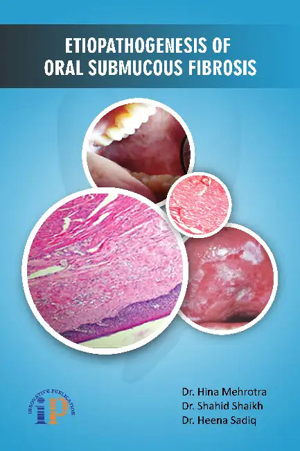 Etiopathogenesis of Oral Submucous Fibrosis by Dr. Hina Mehrotra