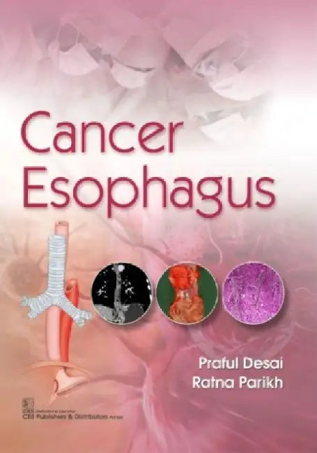 Cancer Esophagus by Praful Desai