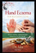 Hand Eczema TCM Management Guide by Ida