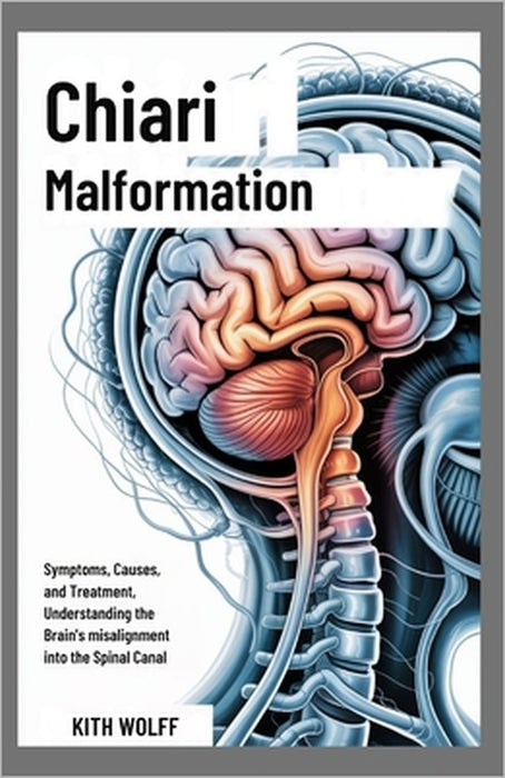 Chiari Malformation: Symptoms, Causes, and Treatment, Understanding the Brain's Misalignment into the Spinal Canal by Kith Wolff
