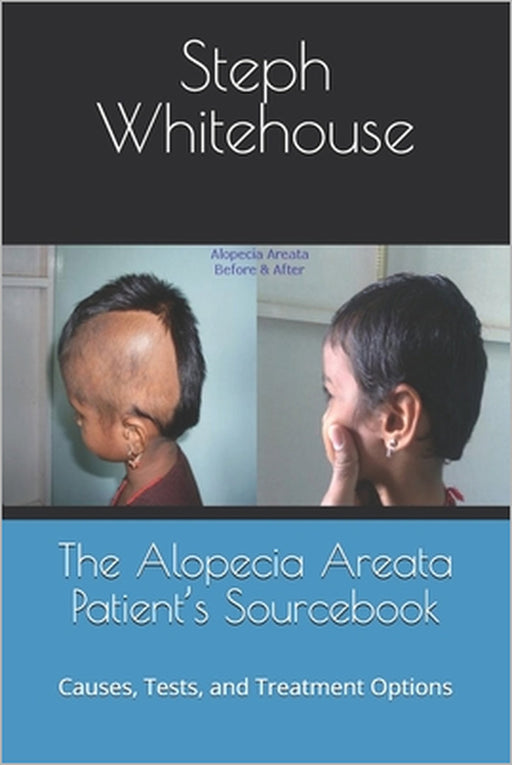 The Alopecia Areata Patient's Sourcebook: Causes, Tests, and Treatment Options by Steph E. Whitehouse Mat