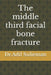 The middle third facial bone fracture by Adil Sulieman