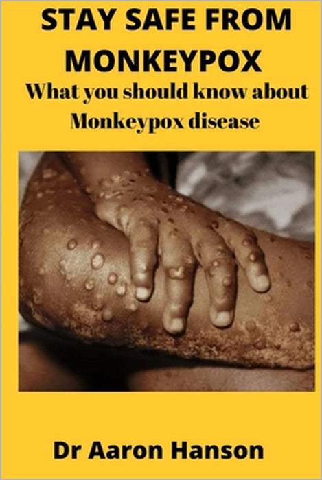 Stay Safe from Monkeypox: What You Should Know About Monkeypox Disease by Aaron Hanson